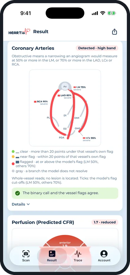 The iPhone app: the coronary map for the sample record.